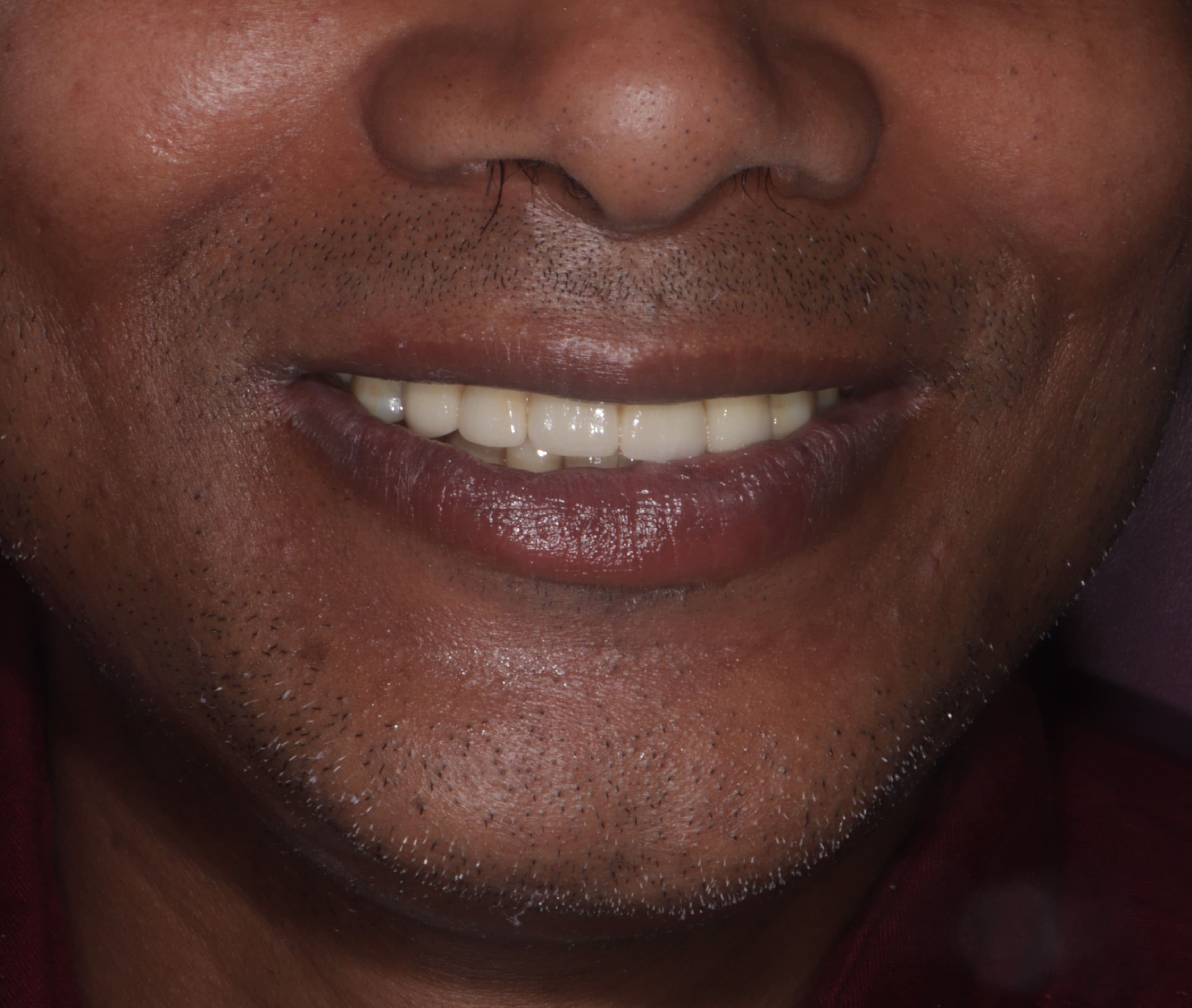 Patient smile after treatment - Case 1