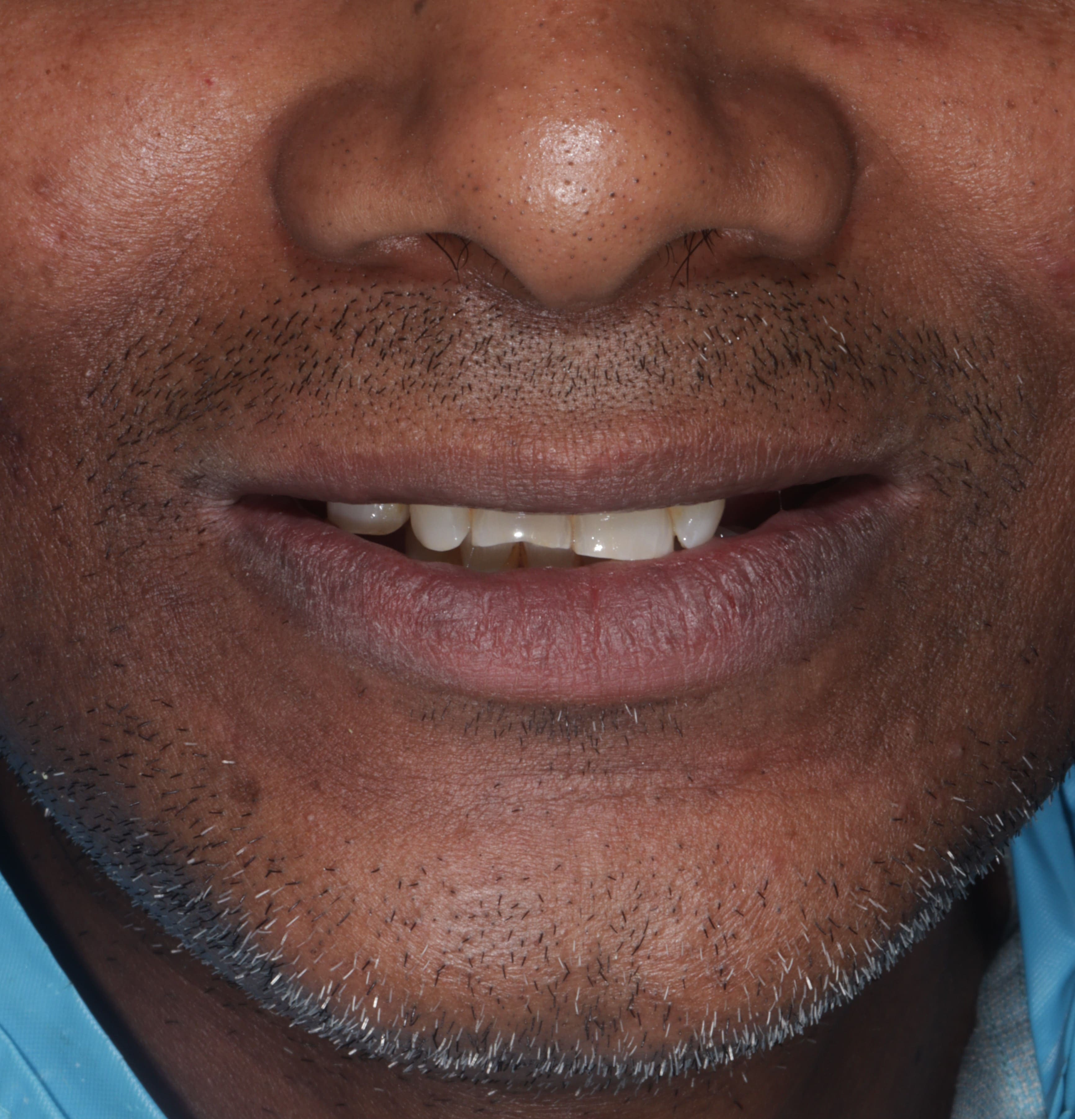 Patient smile before treatment - Case 1